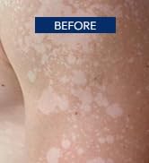 Tinea Versicolor Treatment Cream & Soap: Multi-Functional Clinically Proven Cream for Athlete's F...