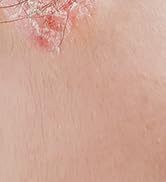 Folliculitis Treatment Cream: Effective Treatment for Folliculitis Scalp Face and Body 100g