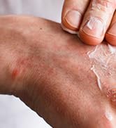 Hermon Powerful Antifungal Ringworm Cream - Effective Treatment for Stubborn Ringworm, Jock Itch,...