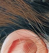 Folliculitis Treatment Cream: Effective Treatment for Folliculitis Scalp Face and Body 100g