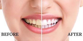 Teeth Whitening Strips
