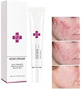 Acne Cream Pimple Cream for Face, Oil Control Pimple Remover Cream Get Rid of Pimples Fast ,for O...