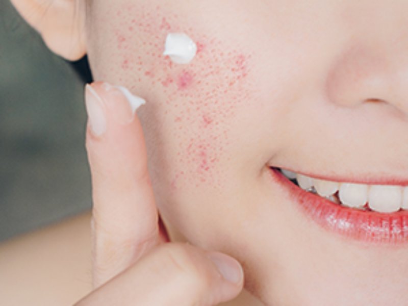 Woman applying acne spot gel to acne blemishes