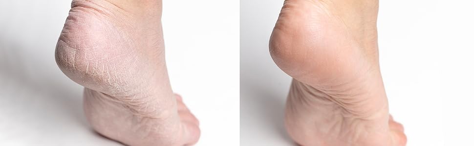 Before and after view of a foot after using Foot Miracle Therapeutic Lotion