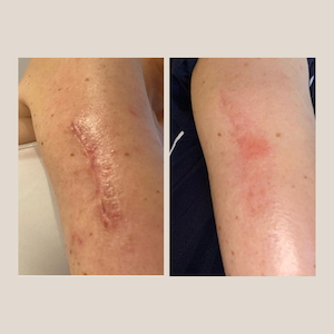 Real Results Arm Scar