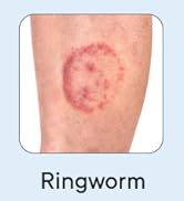 advanced antifungal body wash