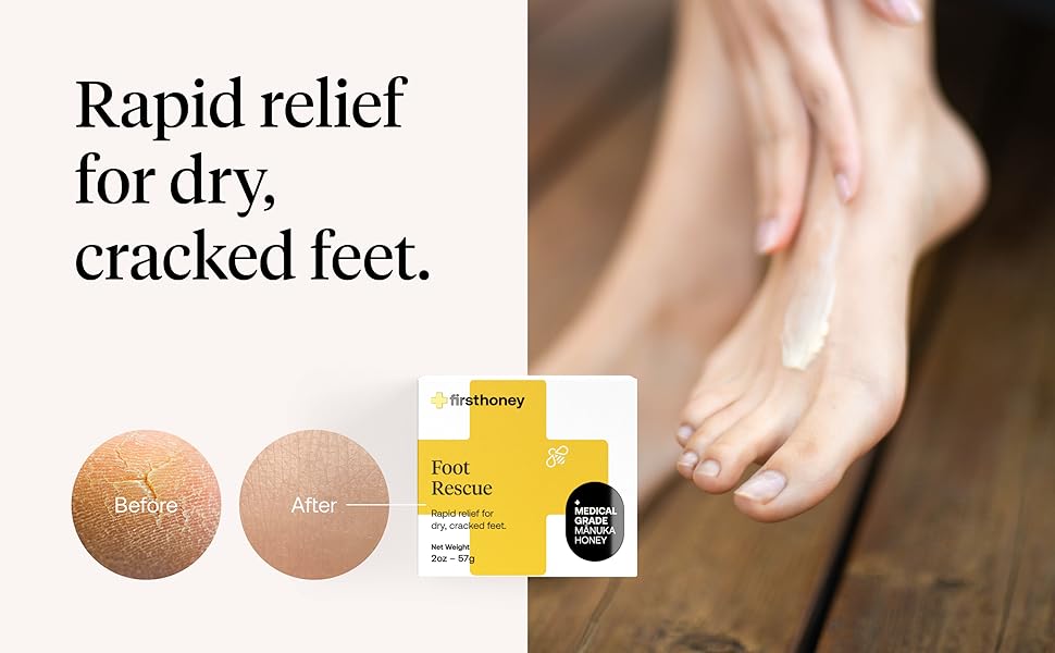 Rapid relief for dry, cracked feet.