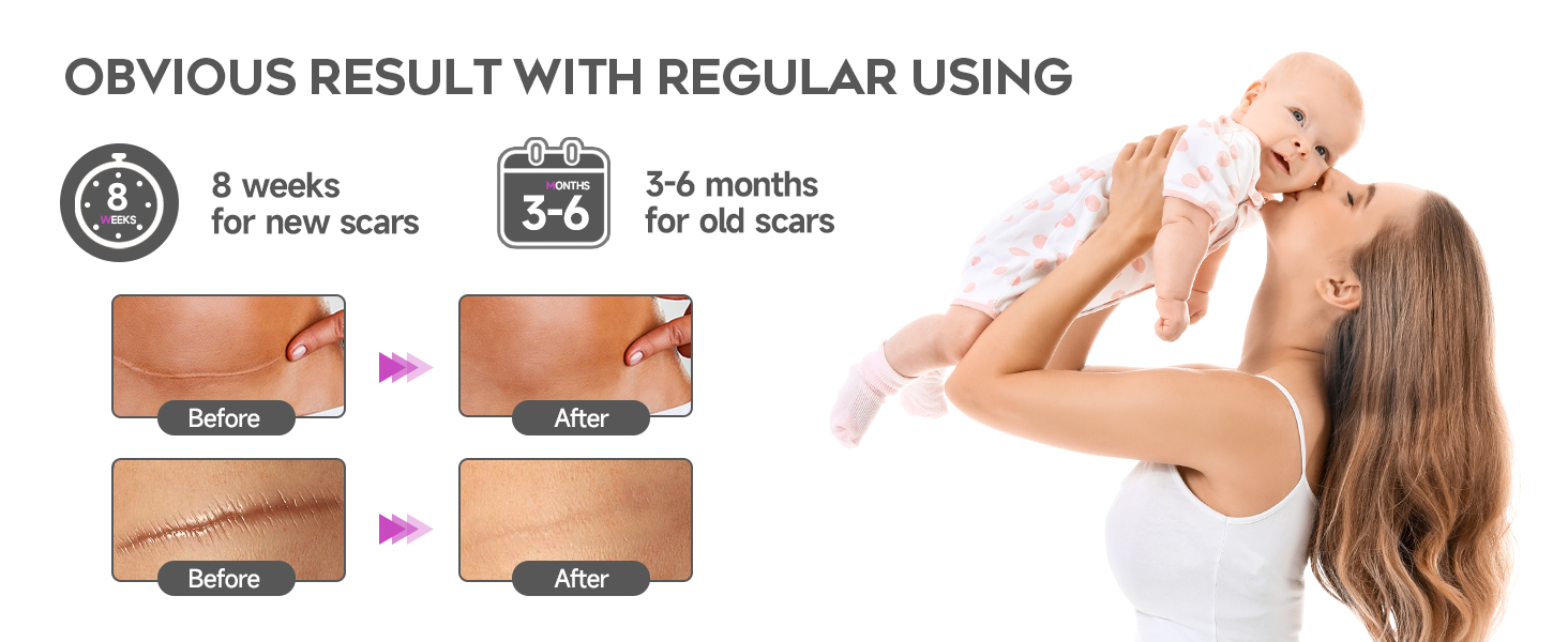 scar removal cream