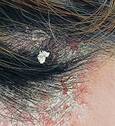 Folliculitis Treatment Cream: Effective Treatment for Folliculitis Scalp Face and Body 100g