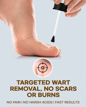 target on wart removal