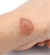 Hermon Powerful Antifungal Ringworm Cream - Effective Treatment for Stubborn Ringworm, Jock Itch,...