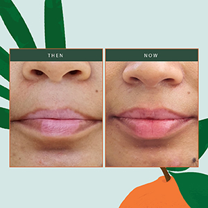 Real results for organic lip balm for uneven lips