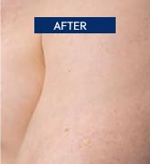 Tinea Versicolor Treatment Cream & Soap: Multi-Functional Clinically Proven Cream for Athlete's F...