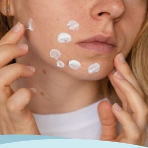 hormonal acne treatment