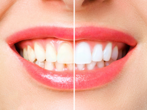 Best teeth whitening products, Clinically proven teeth whitening, Professional teeth whitening gel