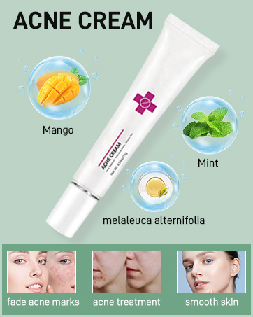 Acne Cream Pimple Cream for Face