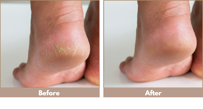 Before and after cracked heels repair with moisturizing foot cream treatment for dry feet rough skin
