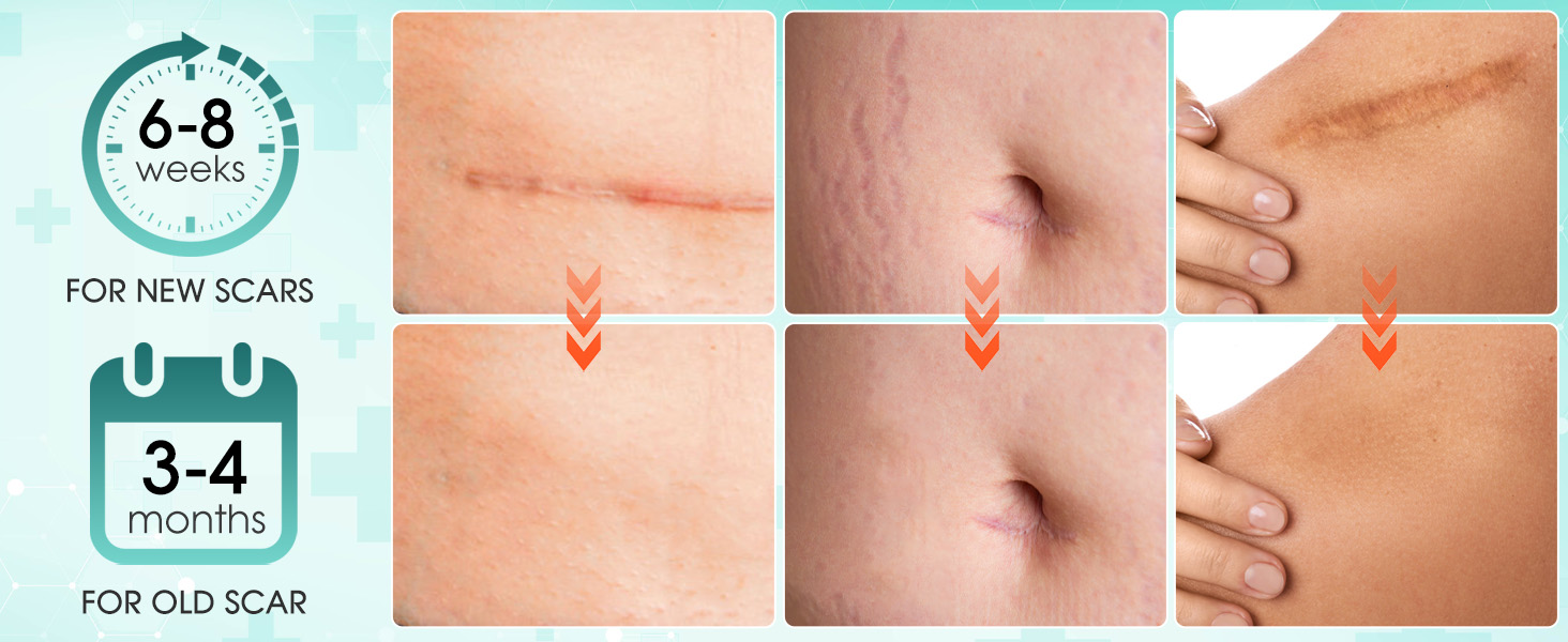 silicone scar gel