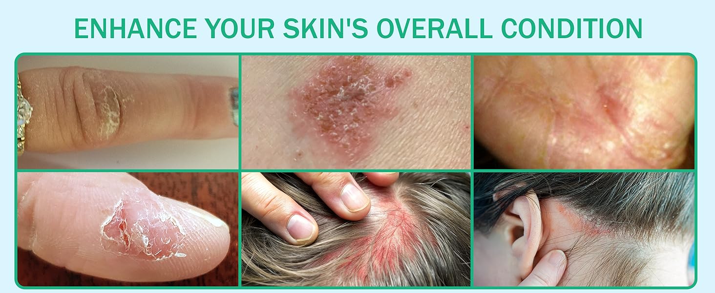 Colosderm 4