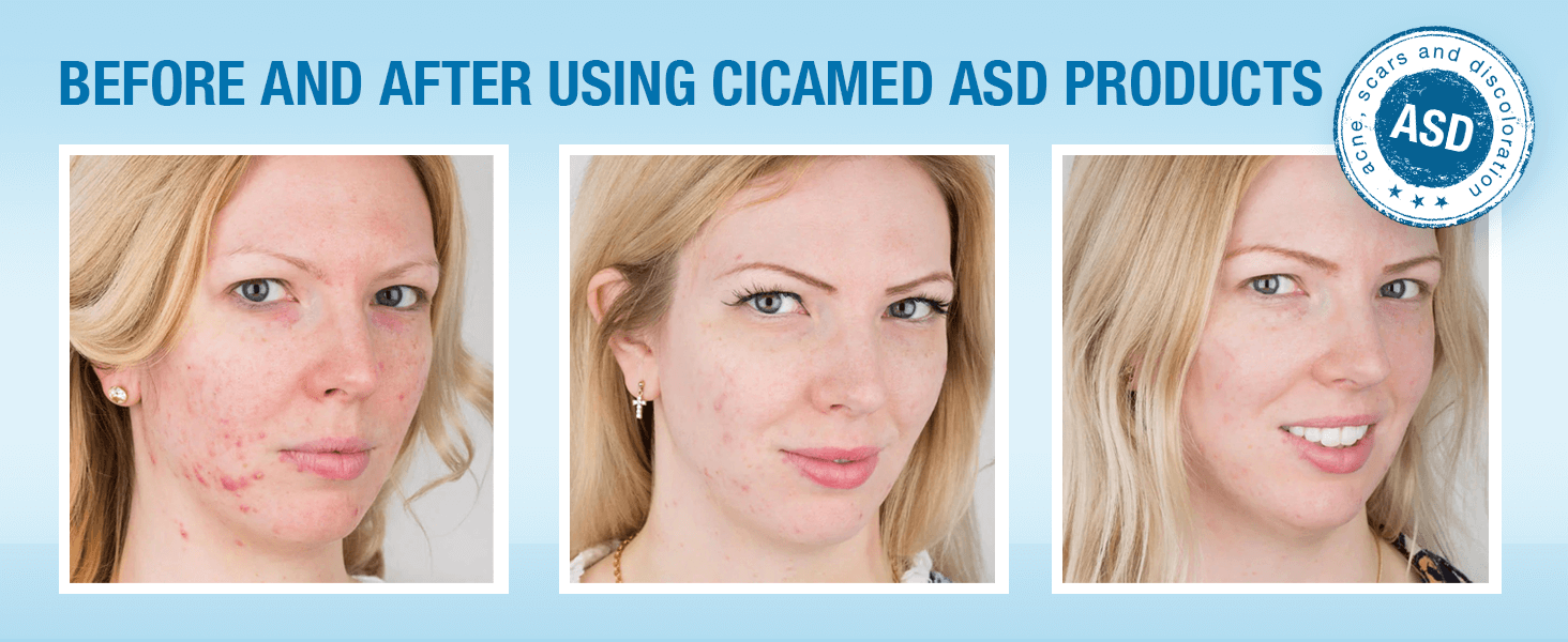 Before and after using Cicamed ASD products