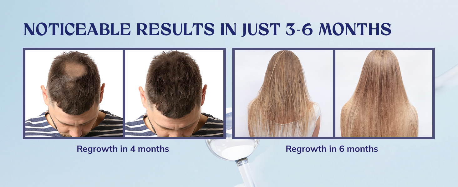 5% Minoxidil Beard Growth Serum