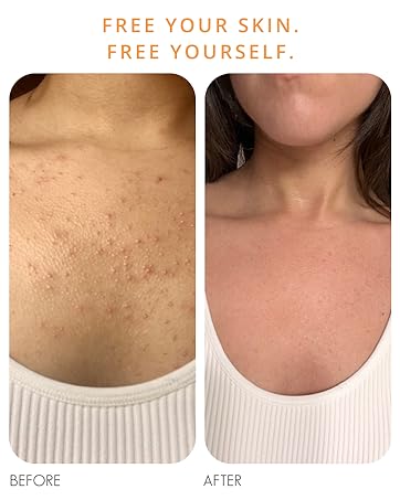 Almond Clear Acne Clearing Mandelic Acid Face and Body Folliculitis Fungal Acne