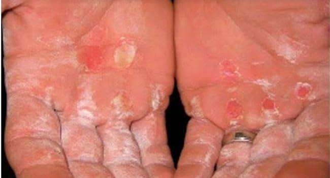 exfoliating heal heels la roche maximum strength exfoliator heel dead body scrub liquido quitar