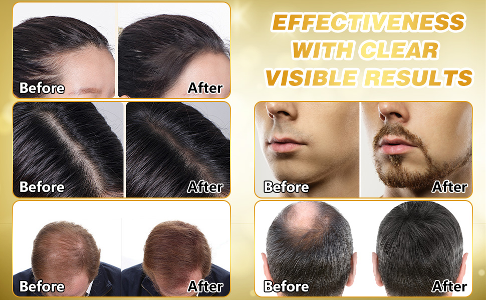 Minoxidil for women