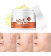 Acne Cream, Salicylic Acid Cystic Acne Treatment For Face, Back Butt Acne Treatment Cream, Acne S...