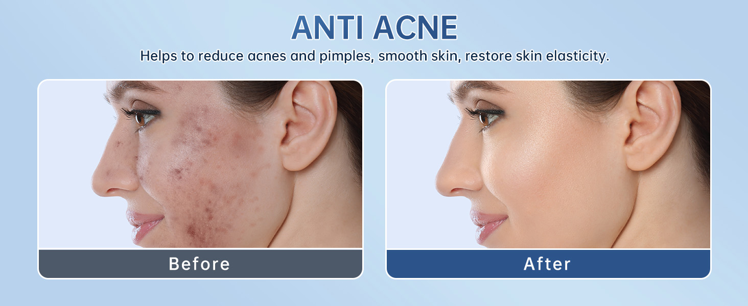 Azelaic Acid Acne Cream