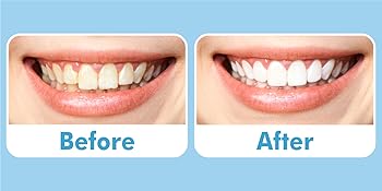 teeth whitening strips