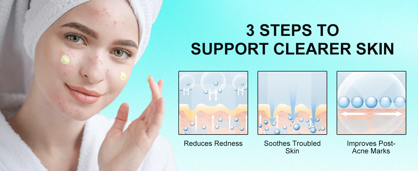 Acne Cream