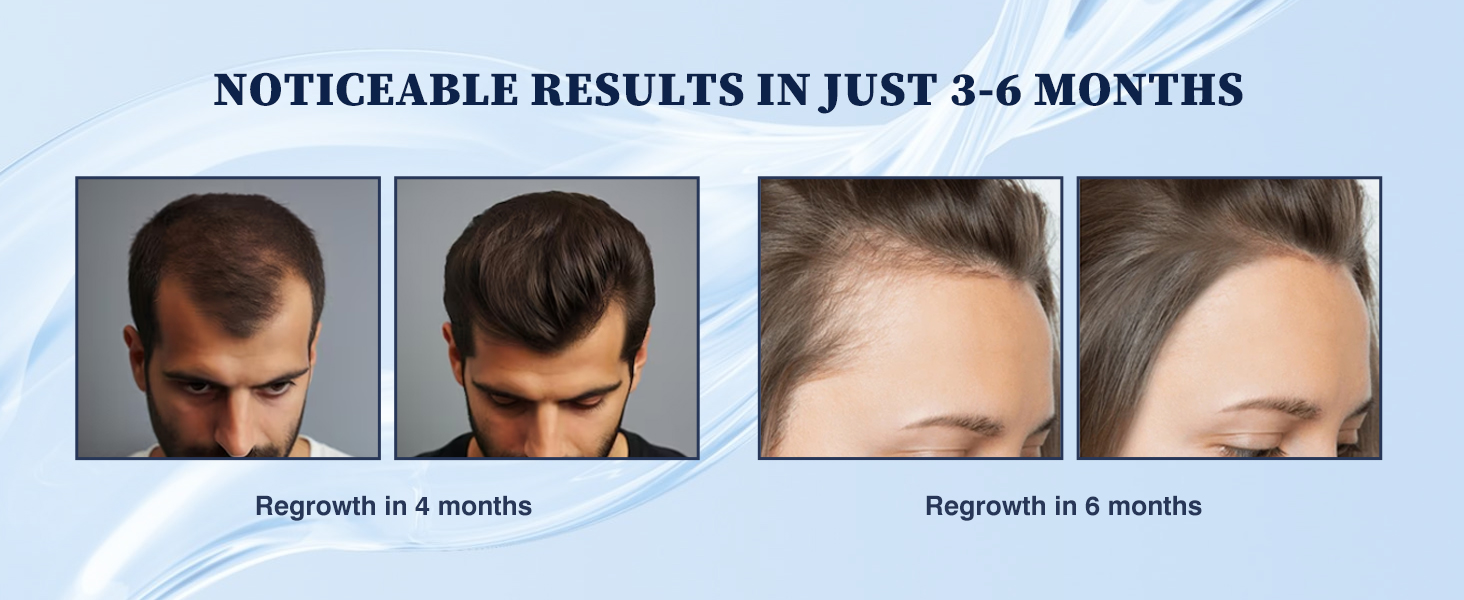 minoxidil for women