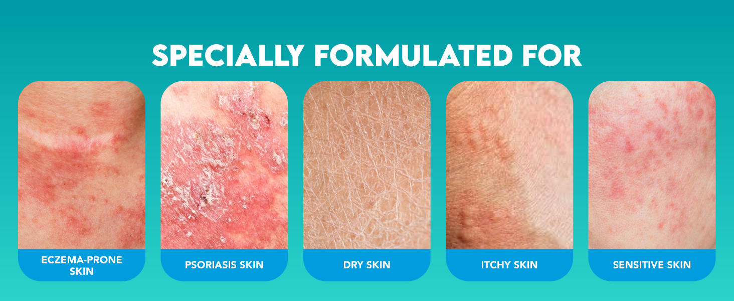 Specially formulated for eczema-prone, dry, itchy, sensitive skin