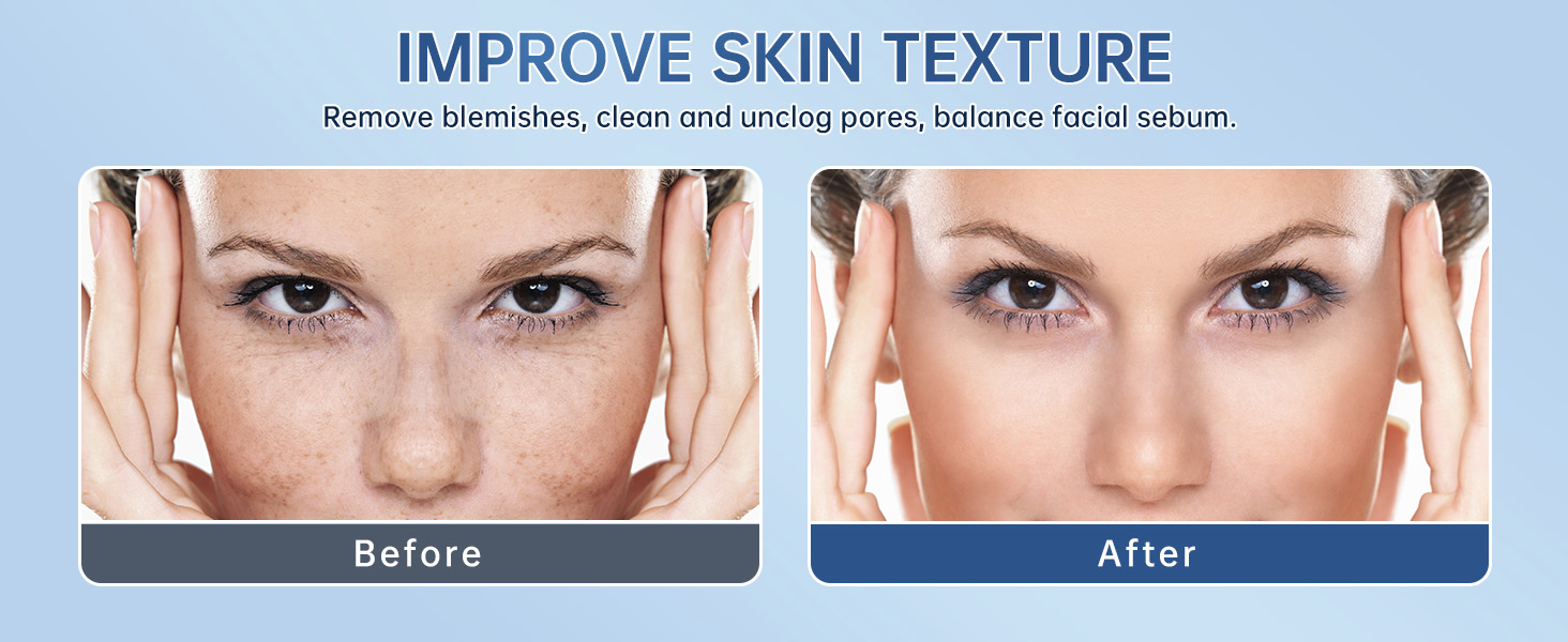 Azelaic Acid Acne Cream