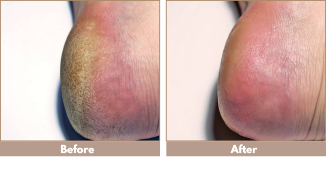 Before after callus remover dry heels cracked skin with hydrating foot cream for women and men