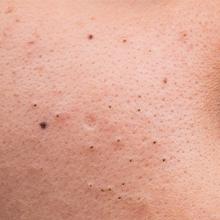 Dark spots due to aging