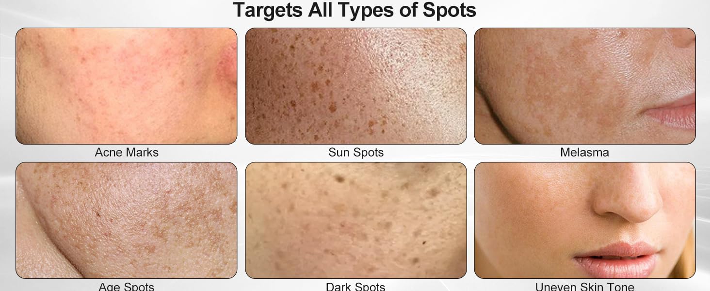 Effective freckle removal essence