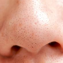 Unsightly blackheads