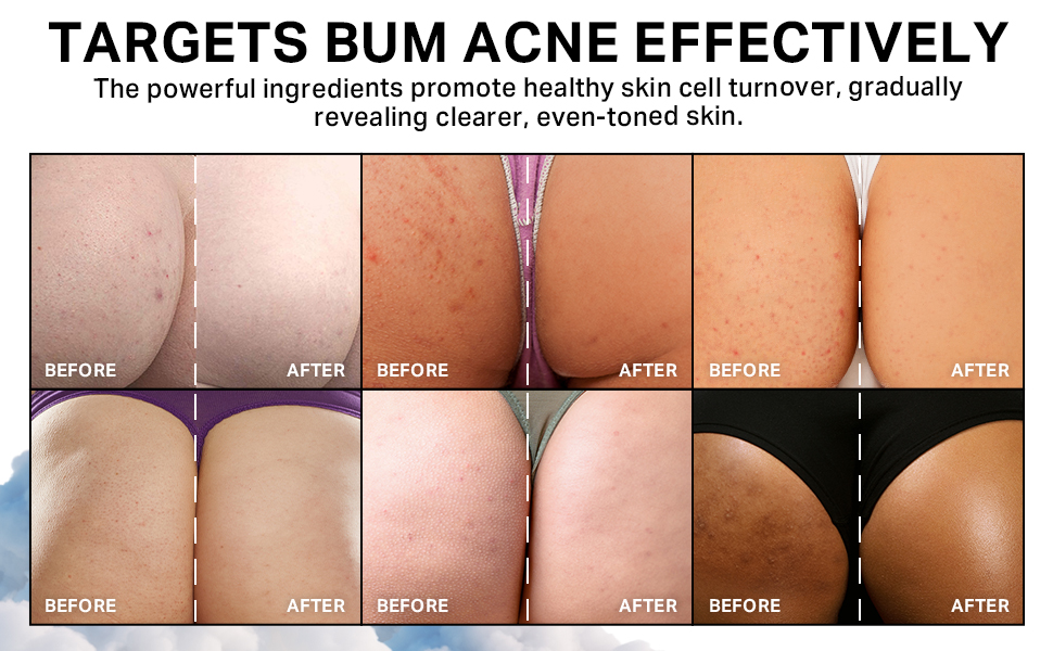 acnefree complexion breakout buns bum acne clearing treatment women bottom clear remover benzyl
