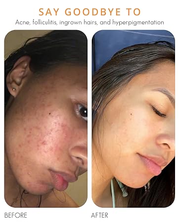 Before and After