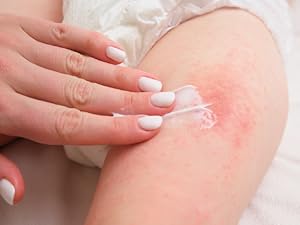 baby diaper rash