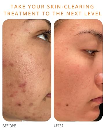 Almond Clear Mandelic Acid Acne Clearing