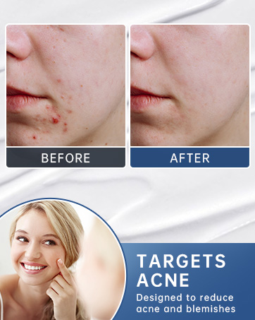 Azelaic Acid Serum for Acne