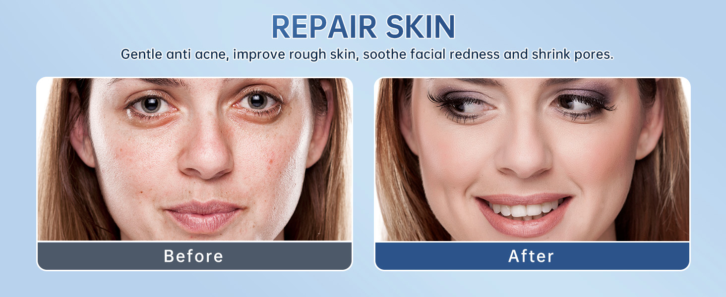 Azelaic Acid Acne Cream