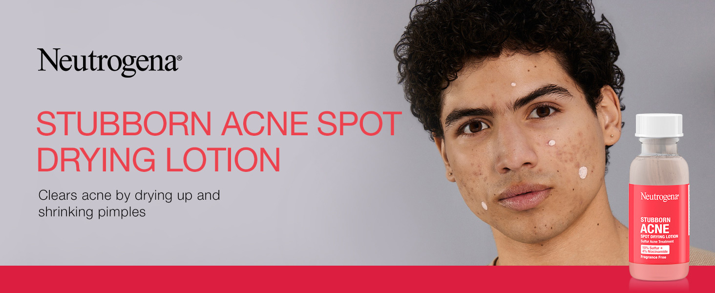 Bottle of Neutrogena Stubborn Acne Spot Drying Lotion next to a women with acne blemishes