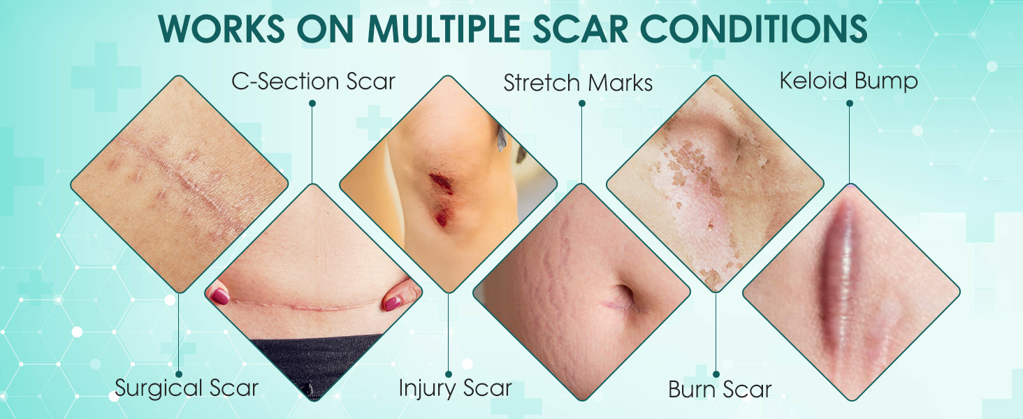 silicone scar gel