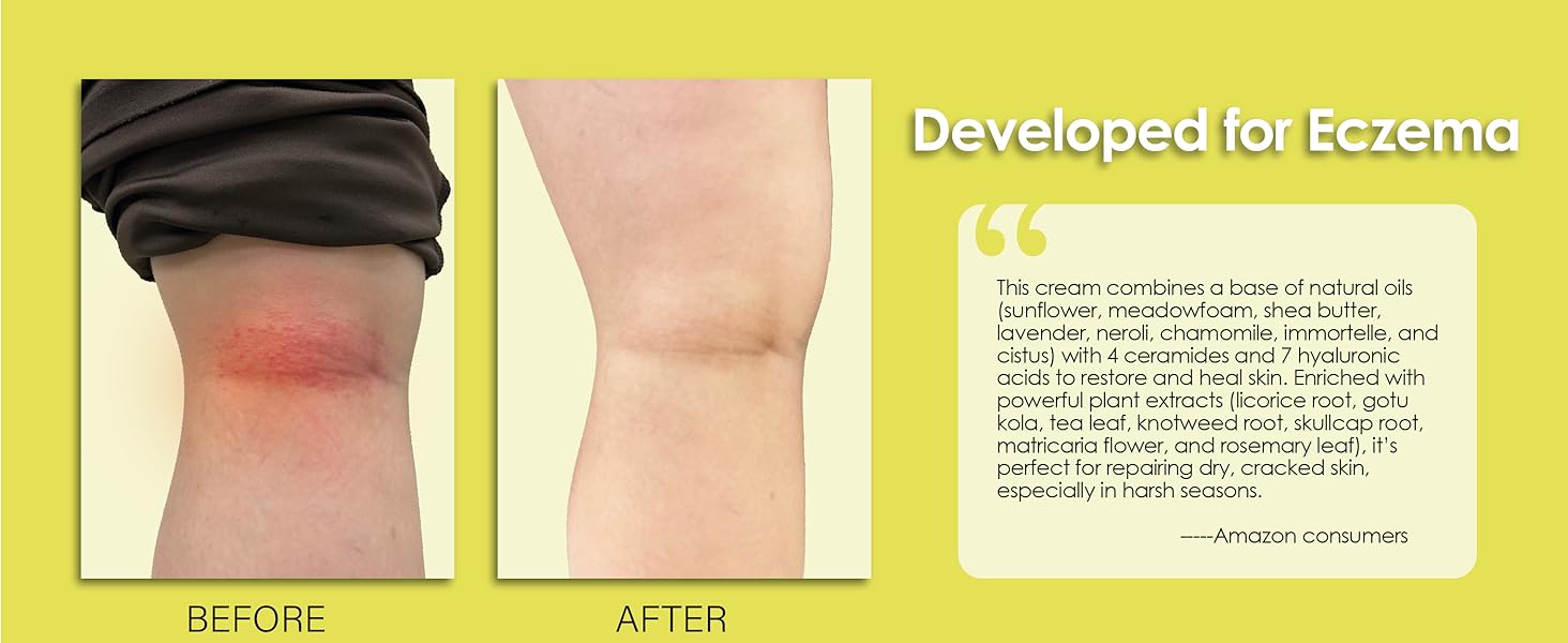 Developed for Eczema