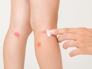 Itchiness from Insect Bites or Allergy