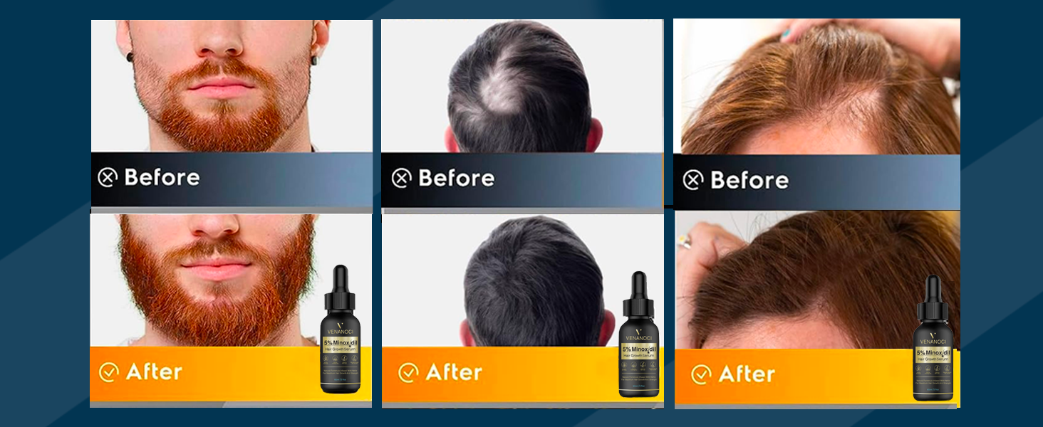minoxidil for men and women hair growth serum